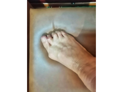 "Кісточка" на нозі (Hallux Valgus)