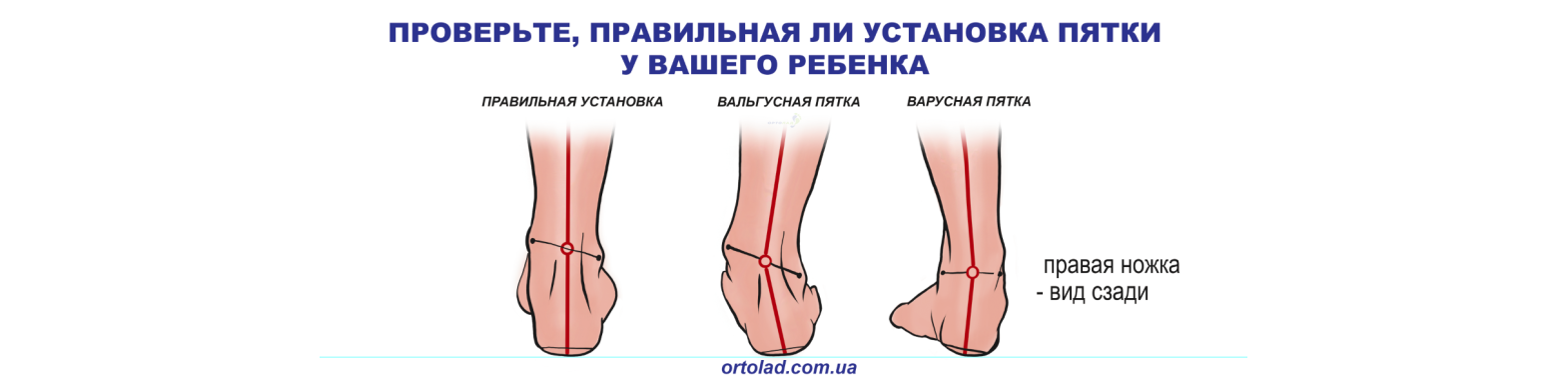 Ортопедические стельки на заказ Днепр | Ортопедические стельки