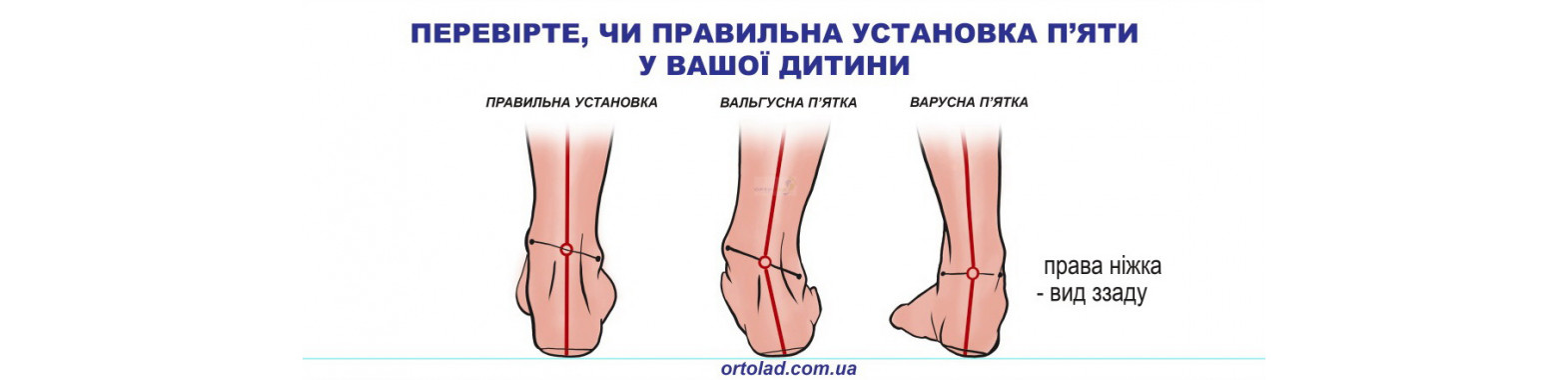 Ортопедичні устілки на замовлення Дніпро | Ортопедичні устілки